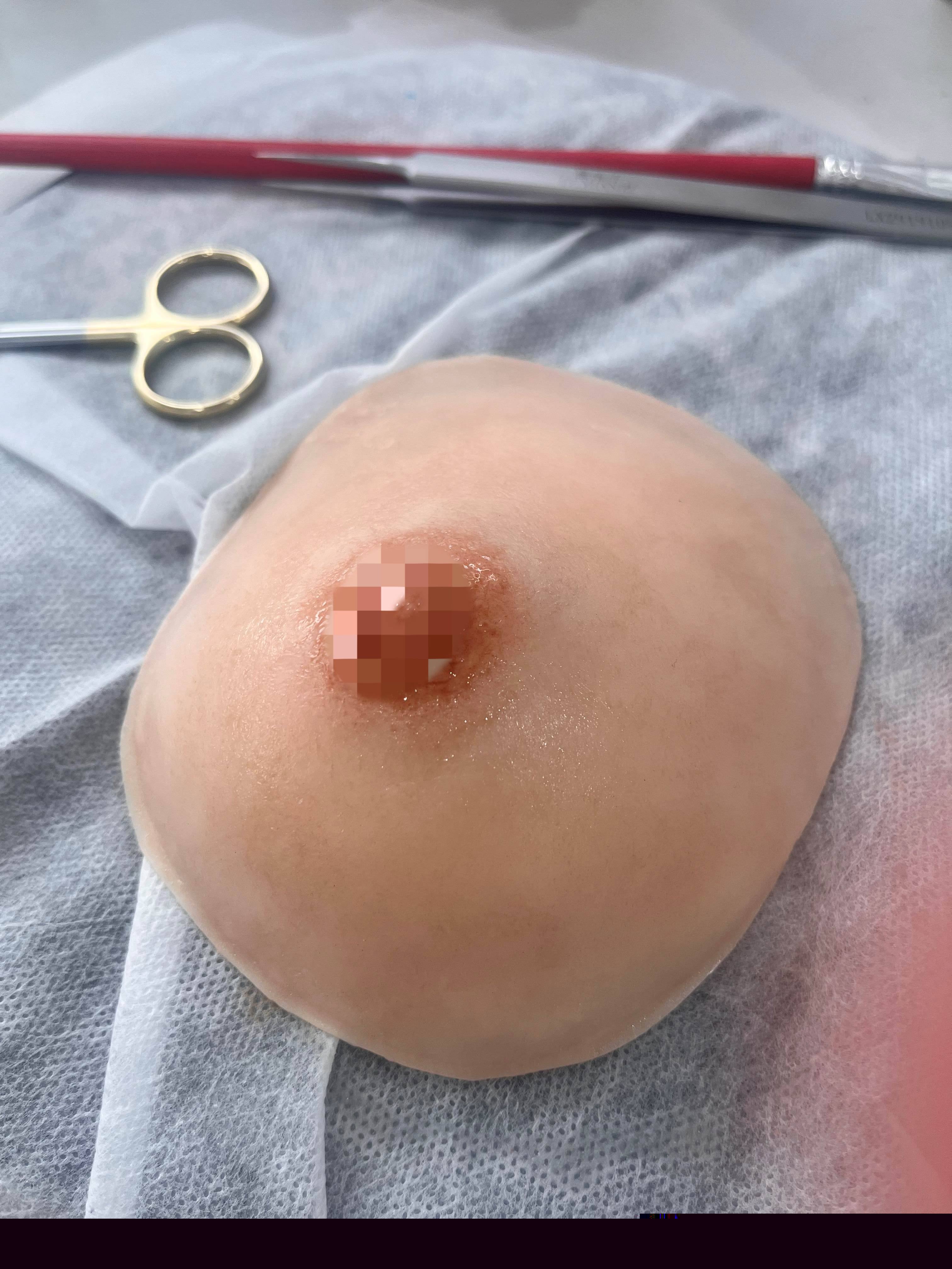 breast prosthesis